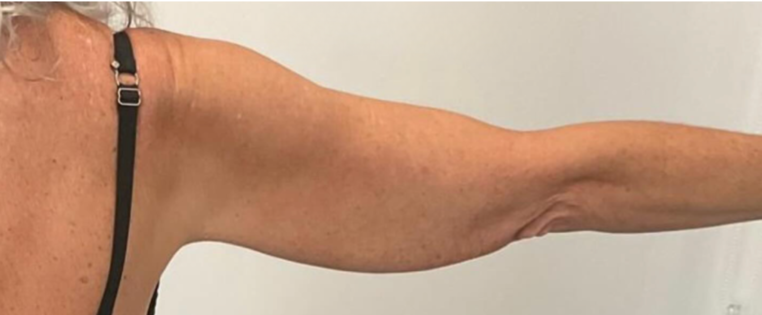 Cadogan Clinic PT Arm Lift After