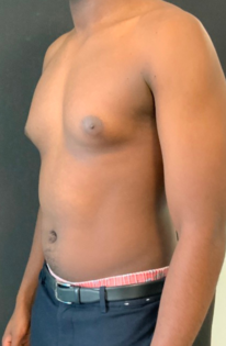 OT Male Chest Lipo Before 1 Three Quarter