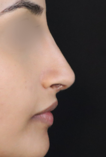 TJ After Rhinoplasty