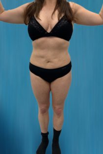 OT Abdomen Lipo After 1 Front