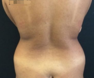 HS Flanks Liposuction Before 1 Back