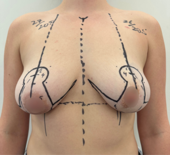 WVN Before Mastopexy