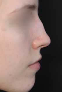 TJ Before Rhinoplasty