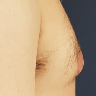 Nipple Reduction Before Image 1