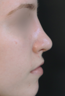 TJ After Rhinoplasty