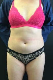 HS Abdomen Lipo Before 1 Front