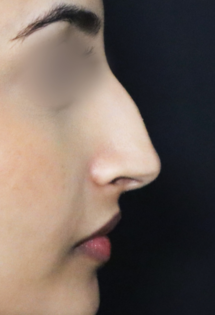 TJ Before Rhinoplasty