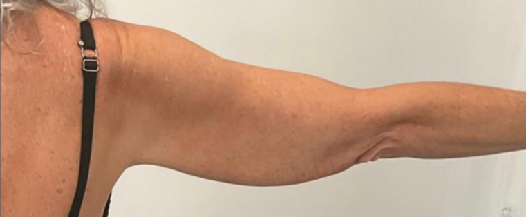 Cadogan Clinic PT Arm Lift Before