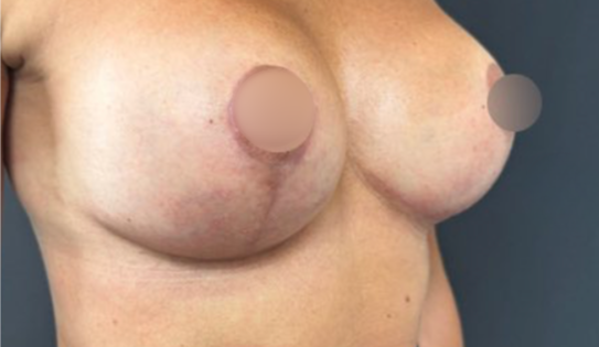 WVN After Mastopexy & Implant Exchange Three Quarter