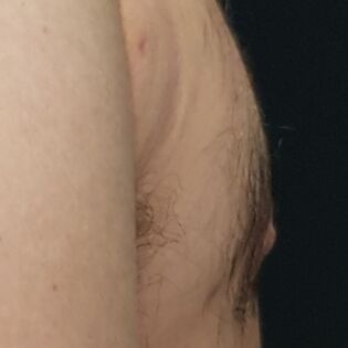 Nipple Reduction After Image 1