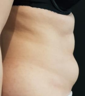 HS Abdomen Liposuction 2 Before Side