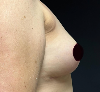 GG After Mastopexy Side