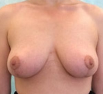 GG After Mastopexy