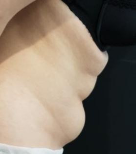 HS Abdomen Liposuction 2 Before Side Bent