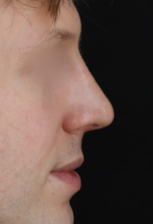 TJ After Rhinoplasty