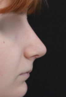 TJ After Rhinoplasty