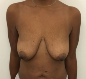 Unknown Before Mastopexy