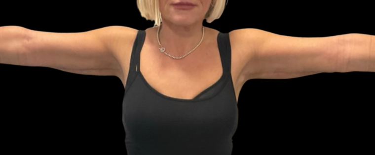 Cadogan Clinic PT Arm Lift After