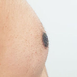 Nipple Reduction After Image 5