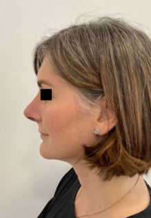 KY After Rhinoplasty