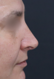 TJ After Rhinoplasty