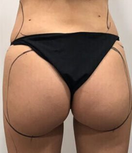 Liposuction Before 2