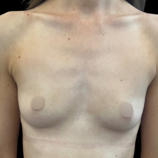 MK Breast Augmentation Before