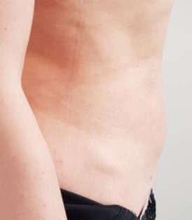 HS Abdomen Liposuction 2 After Side