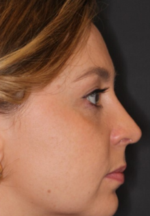 Unknown After Rhinoplasty