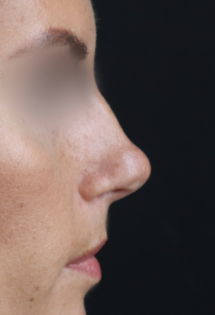 TJ Before Rhinoplasty