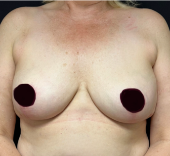 GG After Mastopexy Front