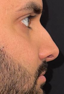 SP Before Rhinoplasty