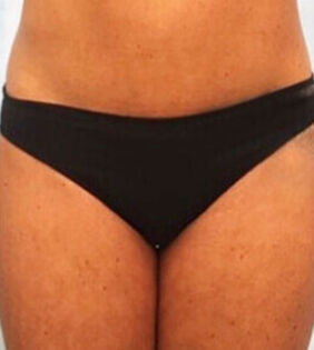 Liposuction Before 3