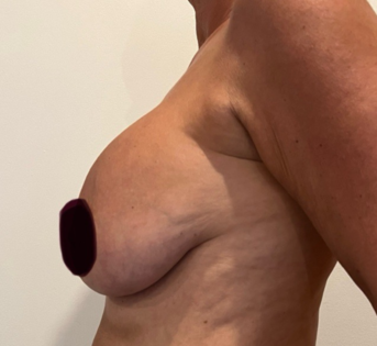 GG Before Mastopexy Side