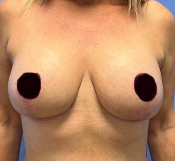 GG After Mastopexy Front