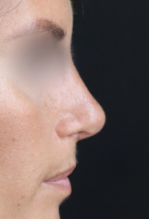 TJ After Rhinoplasty