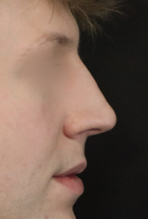 TJ Before Rhinoplasty
