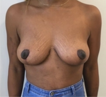 Unknown After Mastopexy