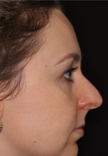 Unknown Before Rhinoplasty