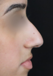 TJ Before Rhinoplasty