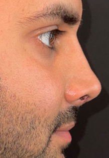 SP After Rhinoplasty
