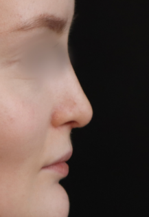 TJ After Rhinoplasty