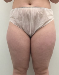 OT Inner Thigh Liposuction 1 Before Front