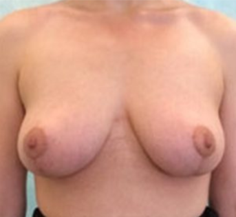 GG After Mastopexy
