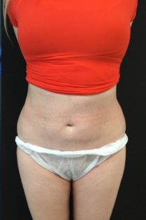 HS Abdomen Lipo After 1 Front