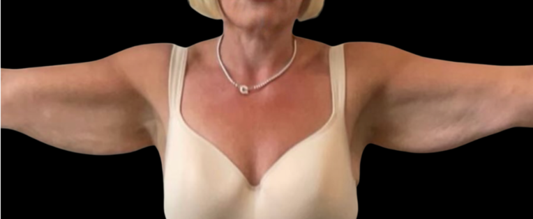 Cadogan Clinic PT Arm Lift Before