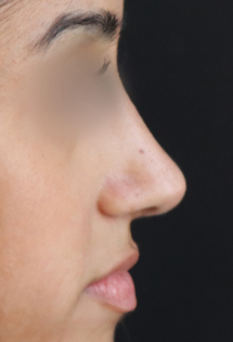 TJ After Rhinoplasty