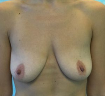 GG Before Mastopexy
