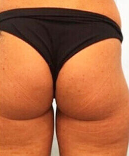 Liposuction Before 4