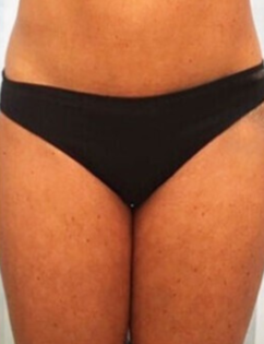 Unknown Inner Thigh Liposuction Before 1 Front